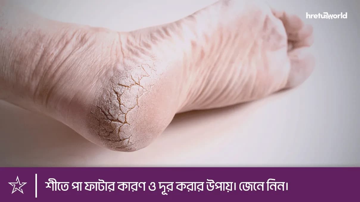 শীতে পা ফাটার কারণ ও দূর করার উপায়। জেনে নিন।