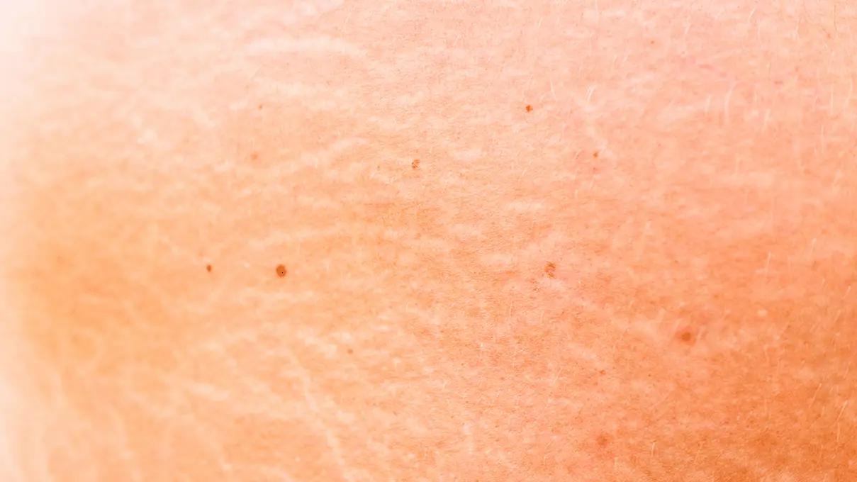 ড্রাই বা শুষ্ক ত্বকের যত্ন কিভাবে নিবেন। 2 Dry Skin