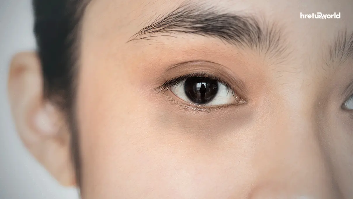 চোখের নিচে ডার্ক সার্কেল দূর করার ৮টি উপায়। 2 dark circles under eyes