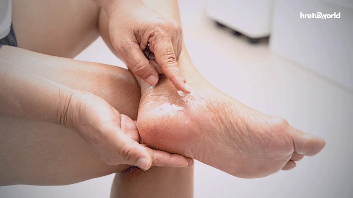 শীতে পা ফাটার কারণ ও দূর করার উপায়। জেনে নিন। 2 care feet