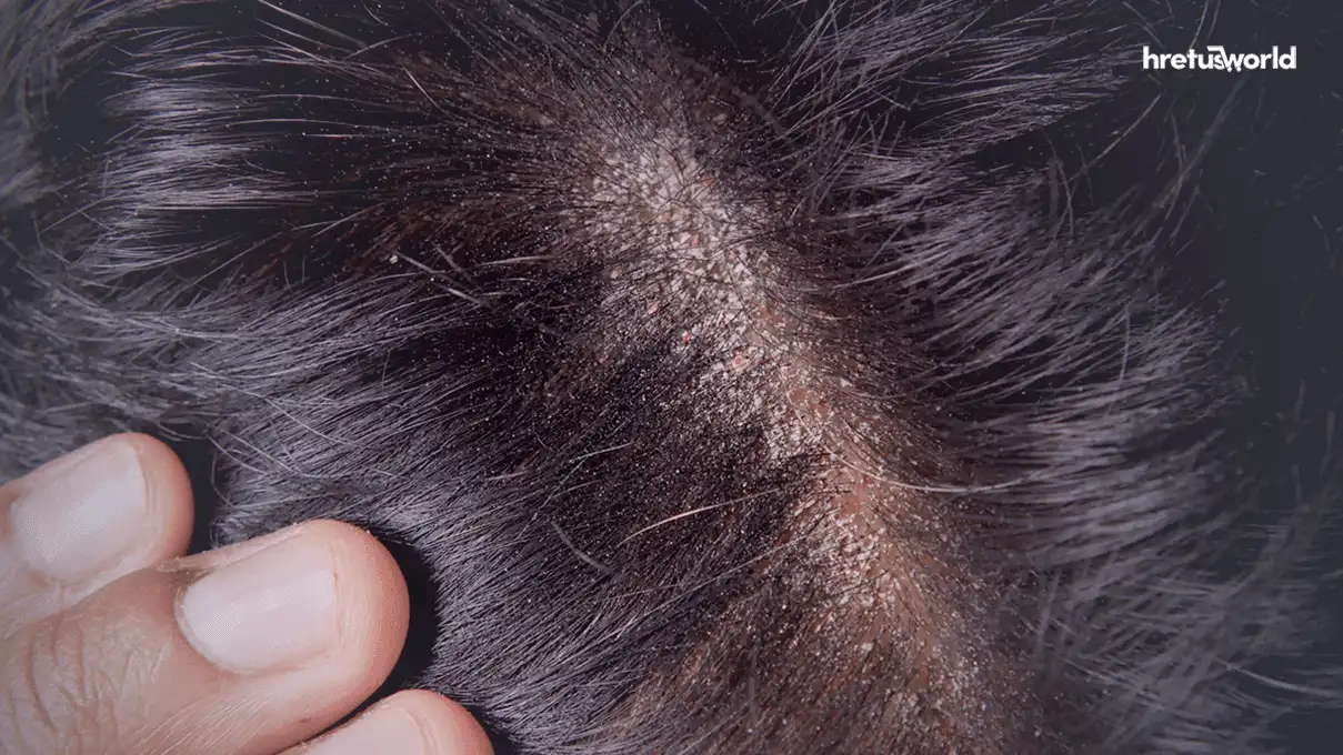 মাথায় অতিরিক্ত খুশকি হলে করনীয়। 2 dandruff